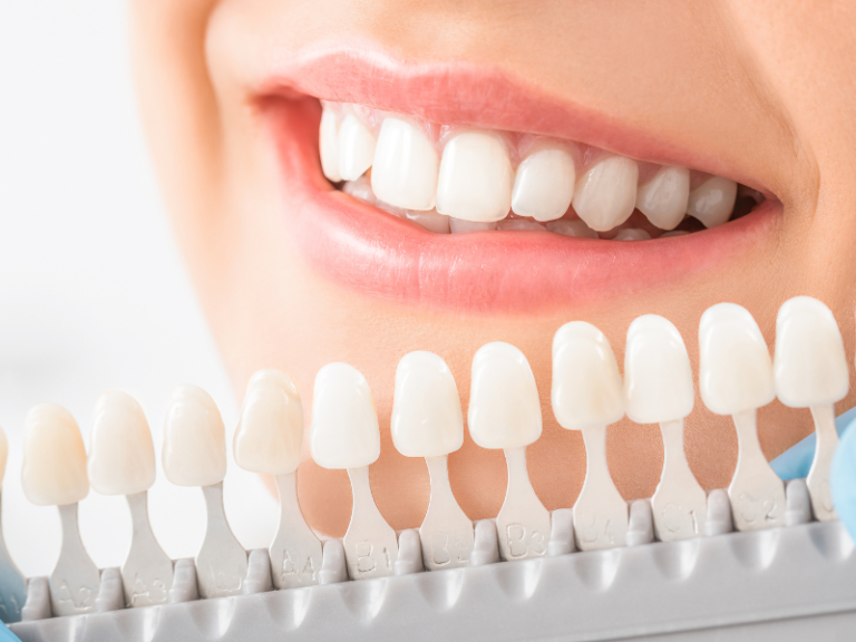 8 Facts about Healthy Teeth Whitening You should know