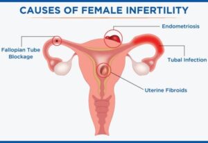 Infertility Management in Noida