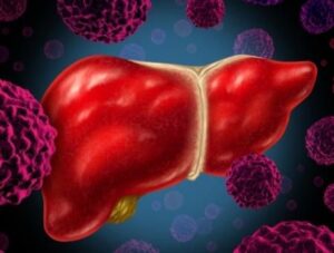 Types of Treatments for Liver Cancer