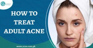 best acne treatment in Lahore