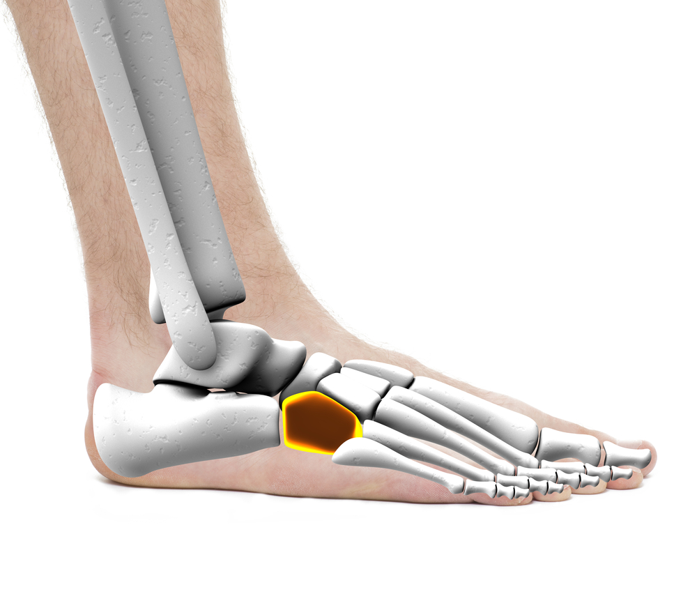 cuboid bone fracture