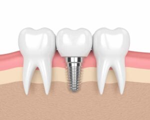 Dental Implants Services in Ontario